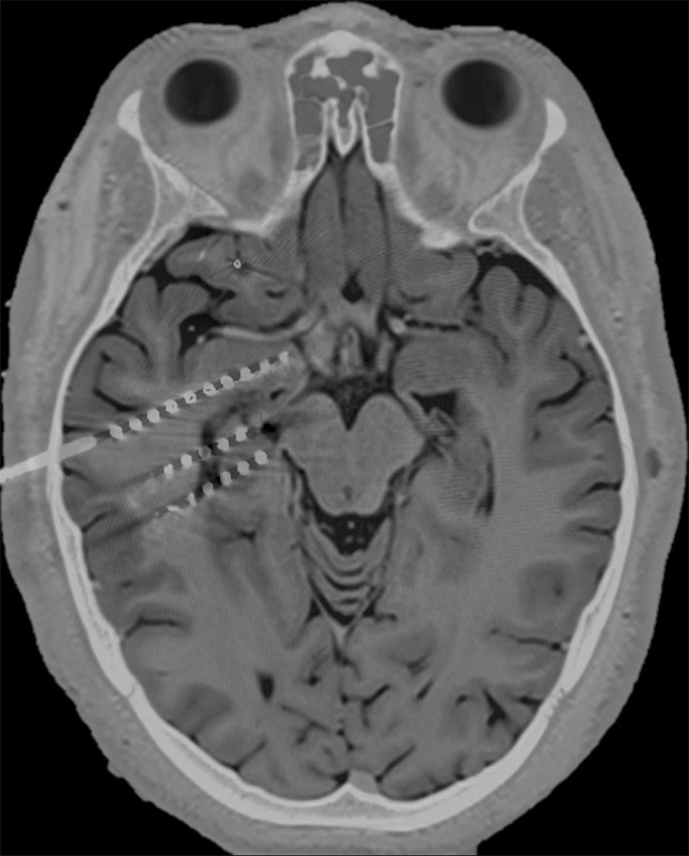 核磁共振和 CT 掃瞄結果顯示，電極會刺激杏仁核(上)、海馬體前部(中)和中部(下) 