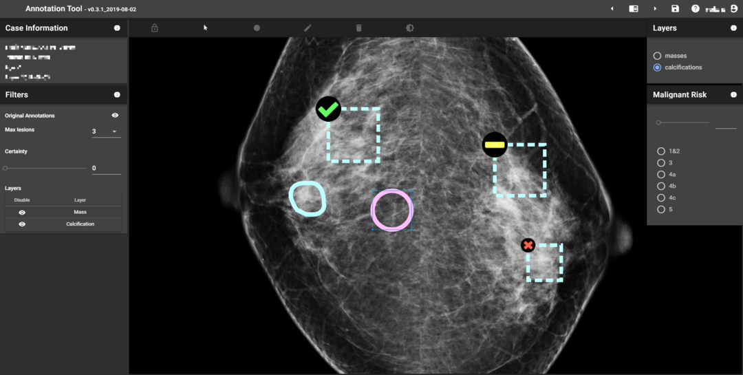 人工智慧(AI)協助乳房X光攝影判讀影像
